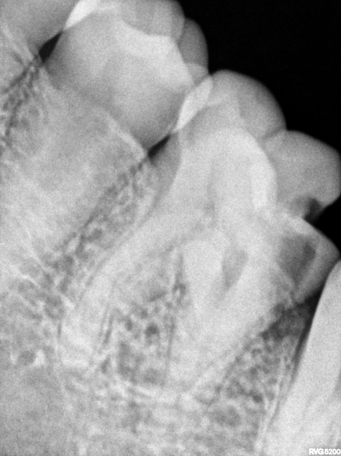 Dental X-ray